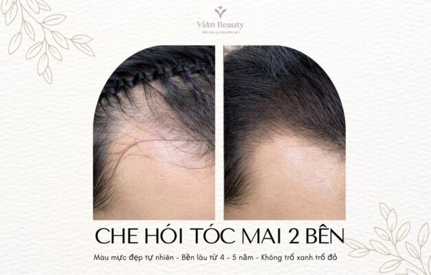 Điêu Khắc Tóc Mai Che Hói